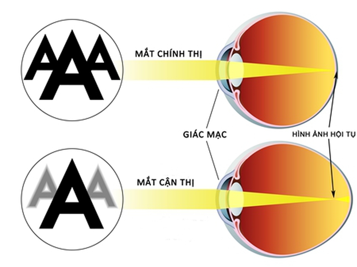 Myopia-CAN THI